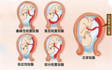 懷孕胎盤